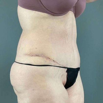 Tummy Tuck Before & After Patient #476
