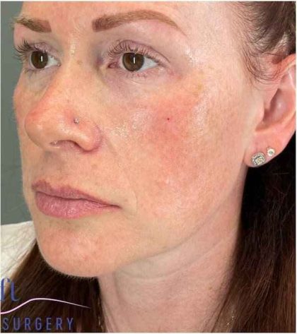 Injectables&Fillers Before & After Patient #118