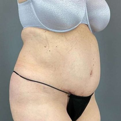 Tummy Tuck Before & After Patient #498