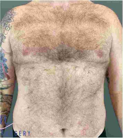 Gynecomastia Before & After Patient #560