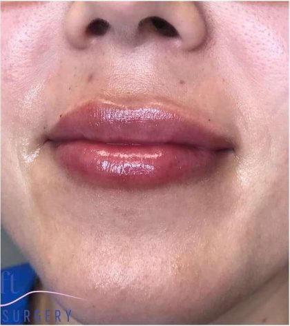 Injectables&Fillers Before & After Patient #145