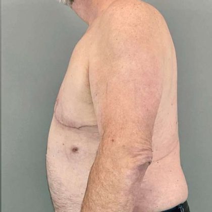 Gynecomastia Before & After Patient #571