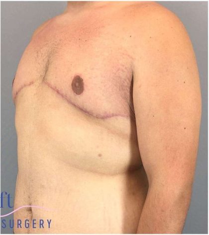 Gynecomastia Before & After Patient #582