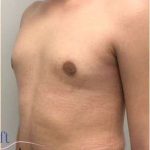 Gynecomastia Before & After Patient #593