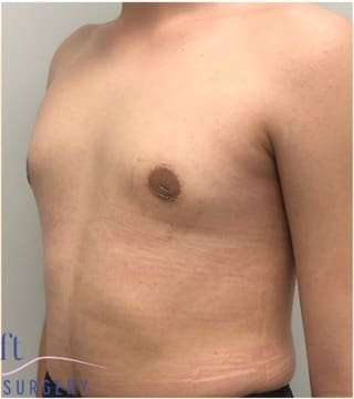 Gynecomastia Before & After Patient #593