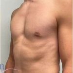 Gynecomastia Before & After Patient #604