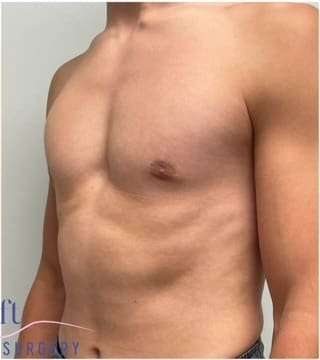 Gynecomastia Before & After Patient #604