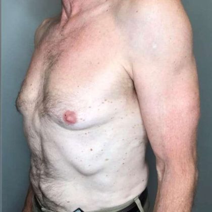 Gynecomastia Before & After Patient #611