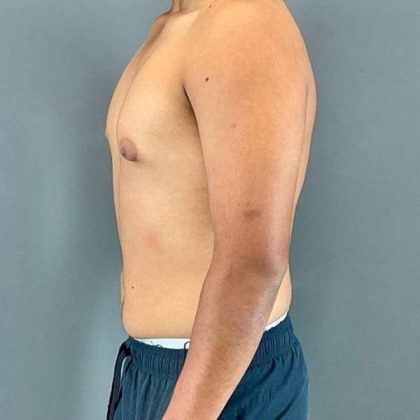 Gynecomastia Before & After Patient #622