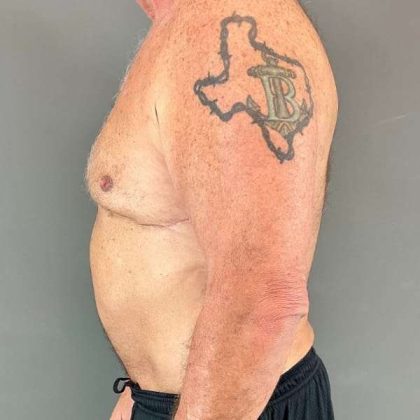 Gynecomastia Before & After Patient #629