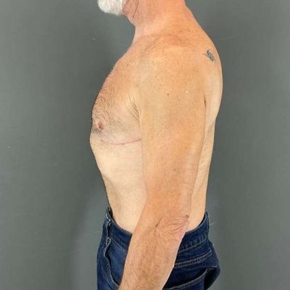 Gynecomastia Before & After Patient #642
