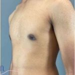 Gynecomastia Before & After Patient #653