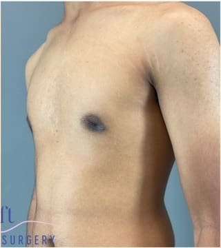 Gynecomastia Before & After Patient #653