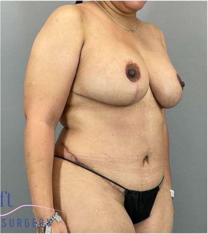 Breast Reduction Before & After Patient #664