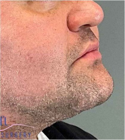 Injectables&Fillers Before & After Patient #150