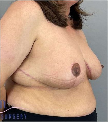 Breast Reduction Before & After Patient #675