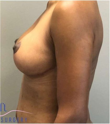 Breast Reduction Before & After Patient #686