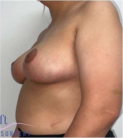 Breast Reduction Before & After Patient #697