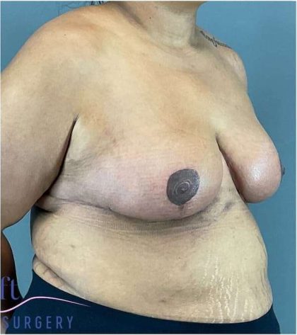 Breast Reduction Before & After Patient #708