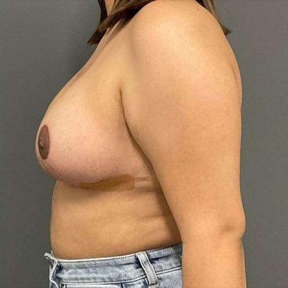 Breast Reduction Before & After Patient #719