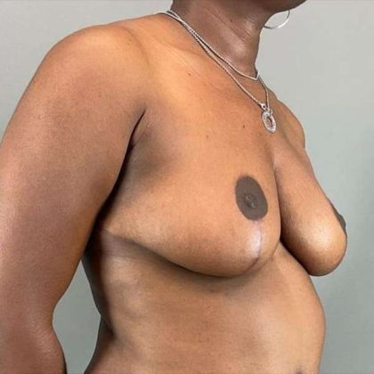 Breast Reduction Before & After Patient #730