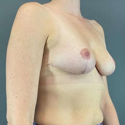 Breast Reduction Before & After Patient #741