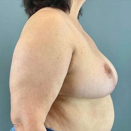 Breast Reduction Before & After Patient #763