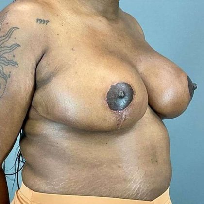 Breast Reduction Before & After Patient #774