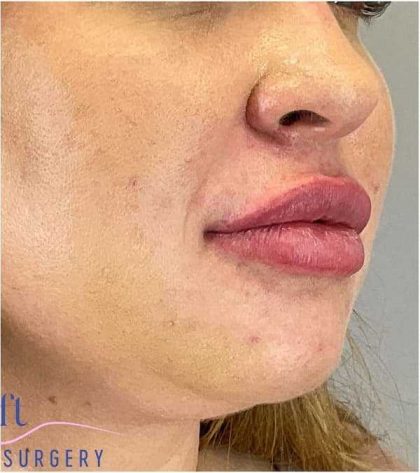 Injectables&Fillers Before & After Patient #155