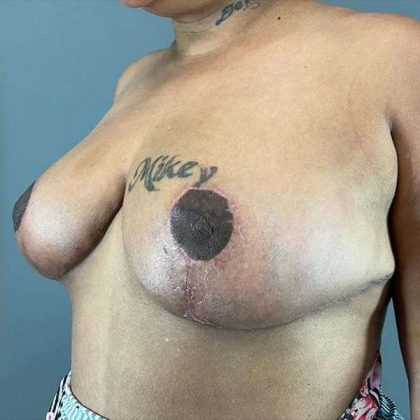 Breast Reduction Before & After Patient #792