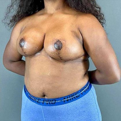 Breast Reduction Before & After Patient #810