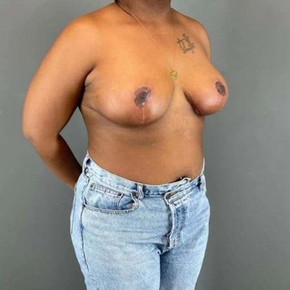 Breast Reduction Before & After Patient #828