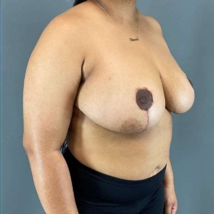 Breast Reduction Before & After Patient #850