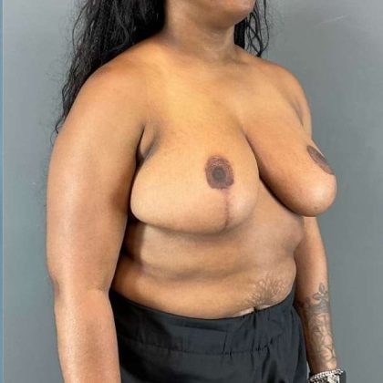 Breast Reduction Before & After Patient #861