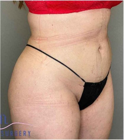 Liposuction Before & After Patient #166