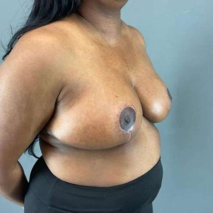 Breast Reduction Before & After Patient #883