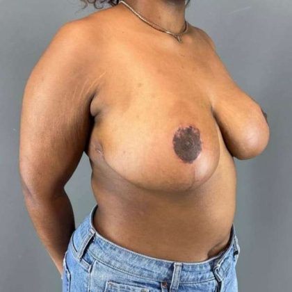 Breast Reduction Before & After Patient #905