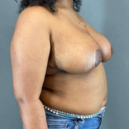 Breast Reduction Before & After Patient #916