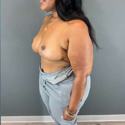 Breast Reduction Before & After Patient #927