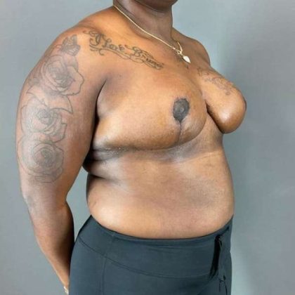 Breast Reduction Before & After Patient #938