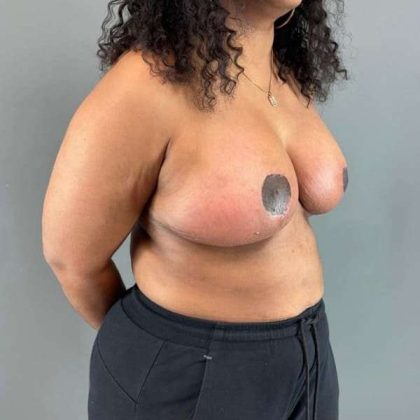 Breast Reduction Before & After Patient #967