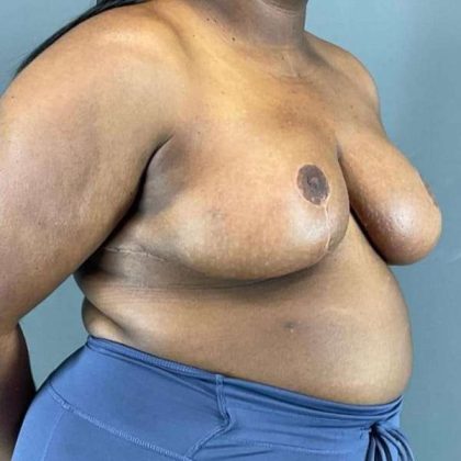 Breast Reduction Before & After Patient #978