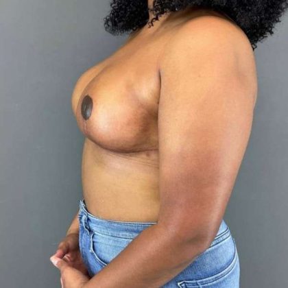 Breast Reduction Before & After Patient #987