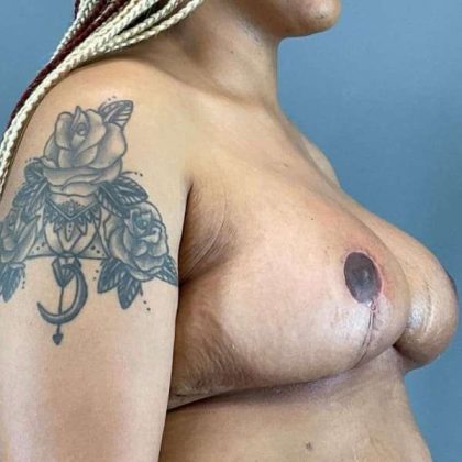 Breast Reduction Before & After Patient #998