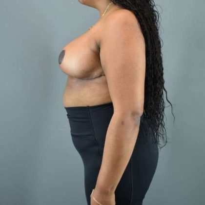 Breast Reduction Before & After Patient #1007
