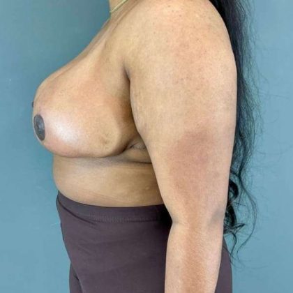 Breast Reduction Before & After Patient #1018