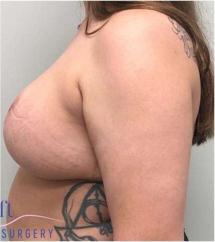 Breast Reduction Before & After Patient #1029