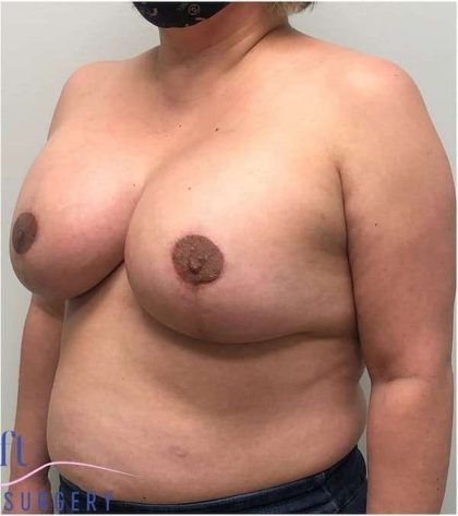 Breast Lift Before & After Patient #1040