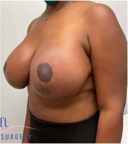 Breast Lift Before & After Patient #1051