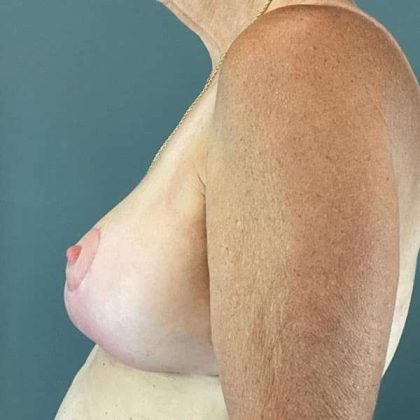 Breast Lift Before & After Patient #1062